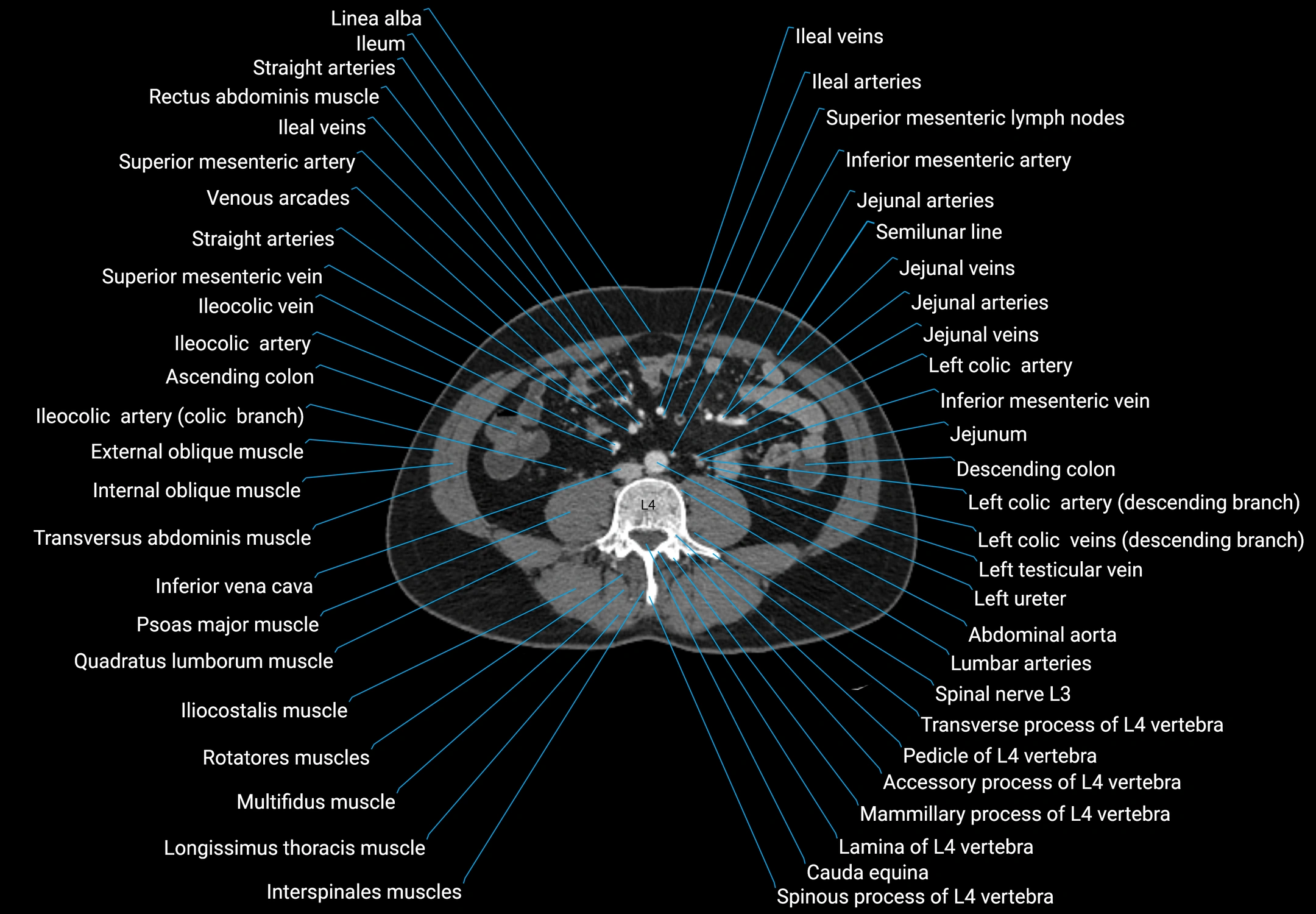 CT male pelvis axial cross sectional anatomy labelled radiology image -00107.webp
